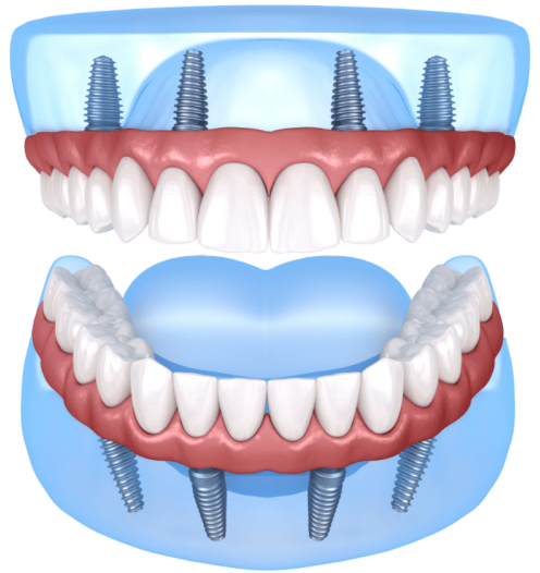 Dental Implants in Columbia
